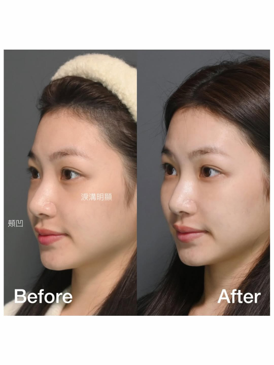 術後心得：日本旅行的「免修圖」奇蹟｜見證案例-Nikki